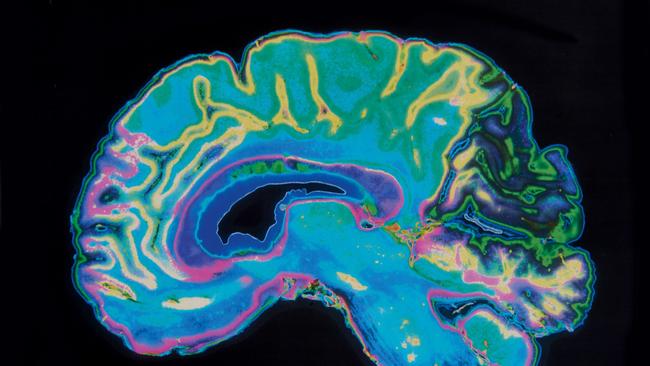 The researchers tracked the teenagers brain development with MRIs over their adolescence. Photo: Getty Images