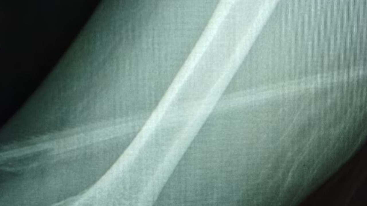 Horror as woman attacked by stingray