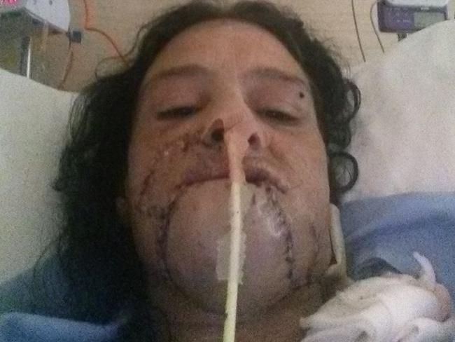 Surgeons had to reattached Ashley Bunn’s chin. Picture: Facebook