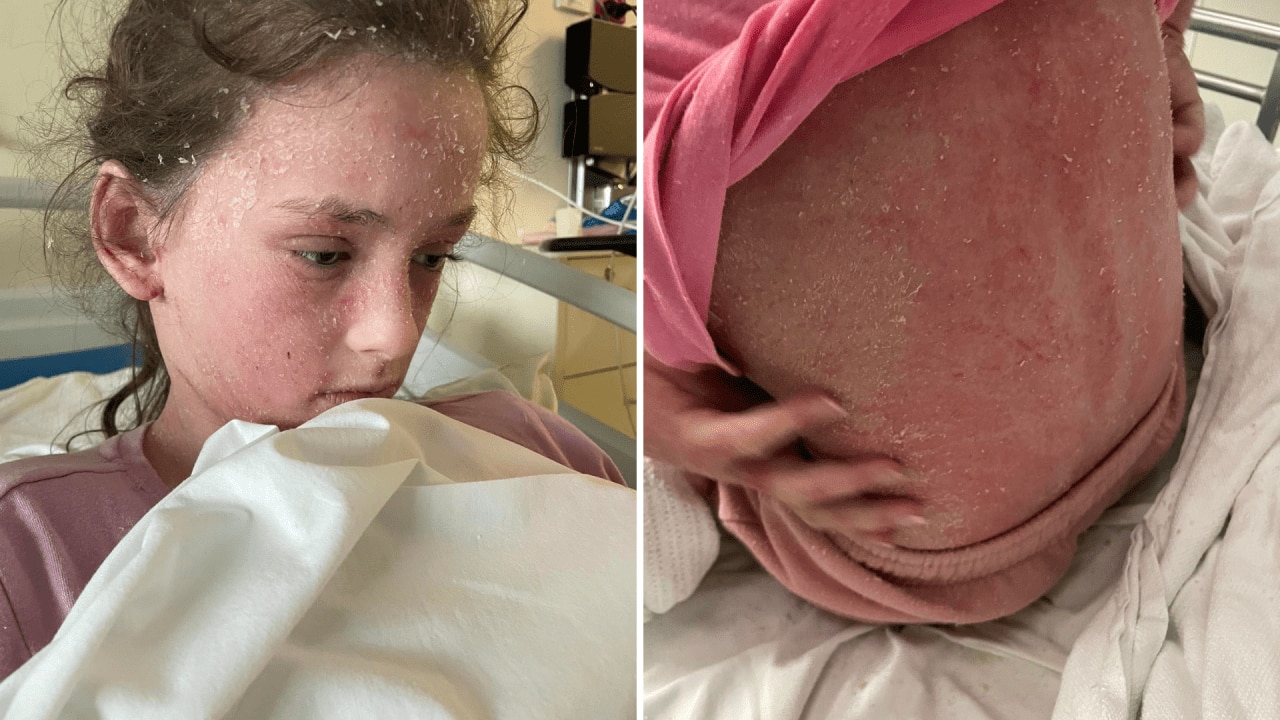 In hospital, Summah's skin flaked and shed like never before. Image: Supplied
