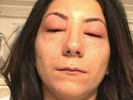 A Canadian woman is warning others about the potential dangers of eyelash extensions after developing a severe allergic reaction to the adhesive used. Picture: Isabelle Kun/Facebook