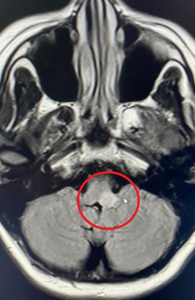 The tumour is located on the brain stem. Picture: Supplied