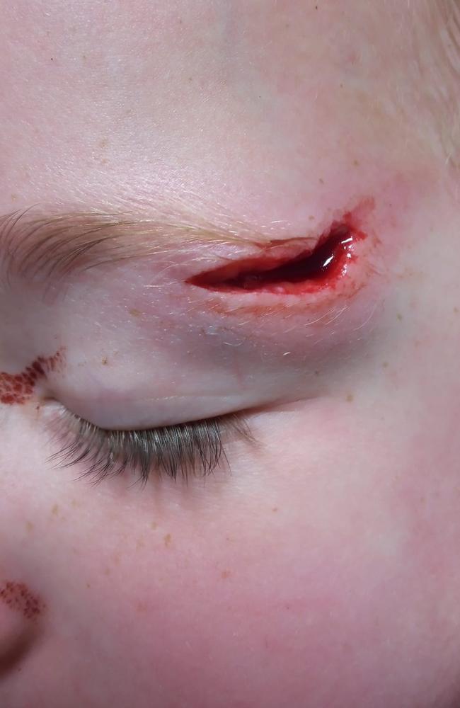 The gash to the little girl’s head required three stitches. Picture: Facebook.