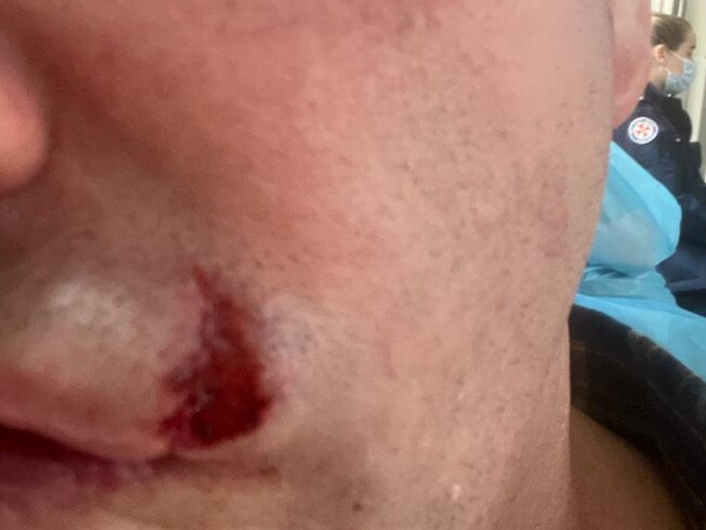 The grazed cheek of a man purported to be Lawrence "Moonman" Mooney following a recent skirmish with an exuberant fan.