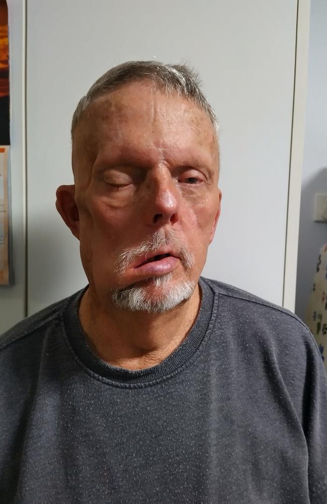 The operation caused ignificant disfigurement to the right side of his face. As a result, he was unable to fly and asked Qantas for a refund.