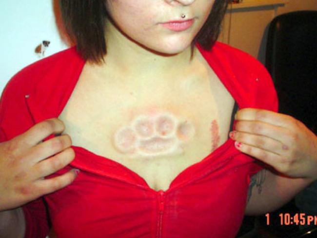 Person wearing body modification silicon moulds inserted under the skin. mod mods art fashion