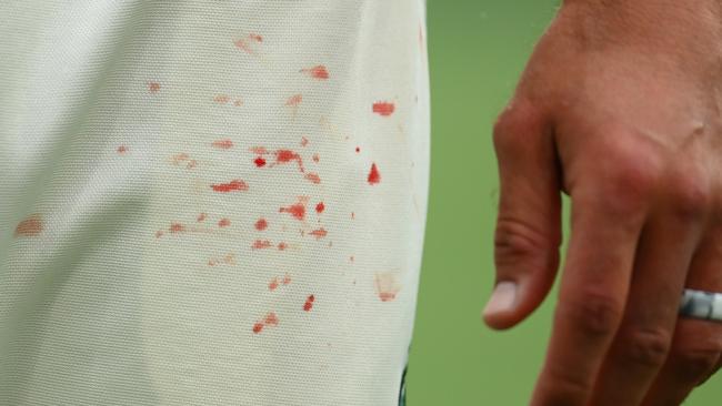 Blood stains are seen on the uniform of Mitchell Starc after his injury.