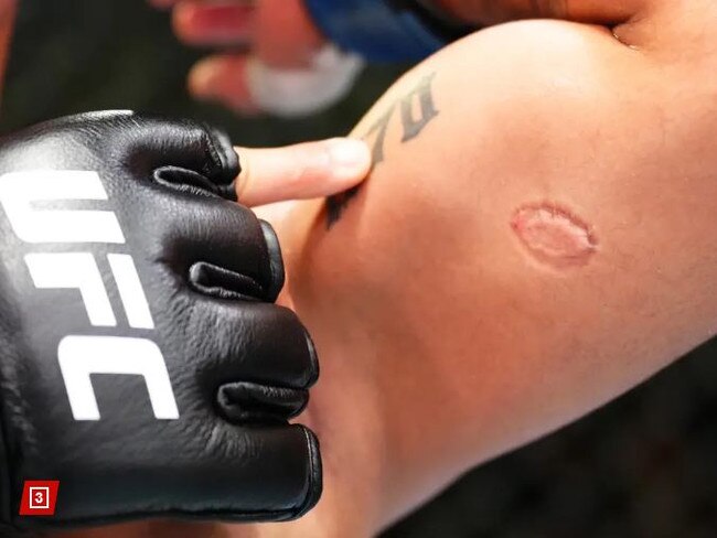 The bite suffered by Andre Lima. Photo: Zuffa LLC via Getty Images