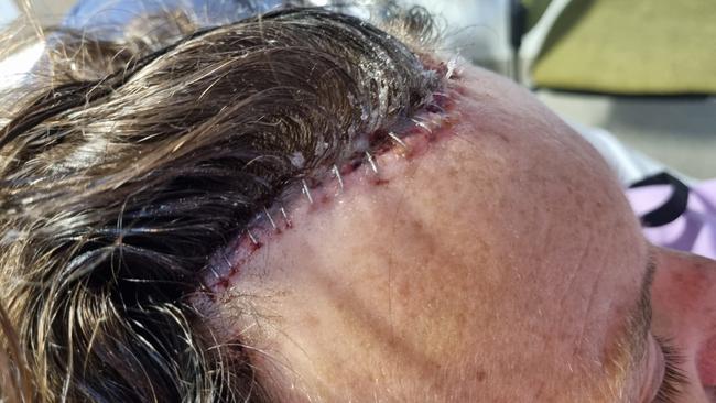 Casey Wright required 34 staples to reattach his scalp.