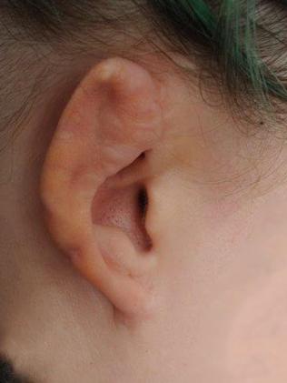 A woman had botched ear surgery.