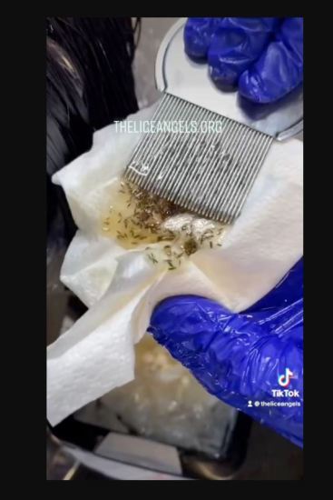 Professional headlice remover shares worst case she's ever seen and admits  head was so bad she wishes she'd WEIGHED it