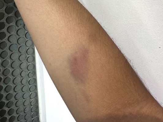 Ms Palomo was left with bruises after the alleged incident. Picture: Supplied