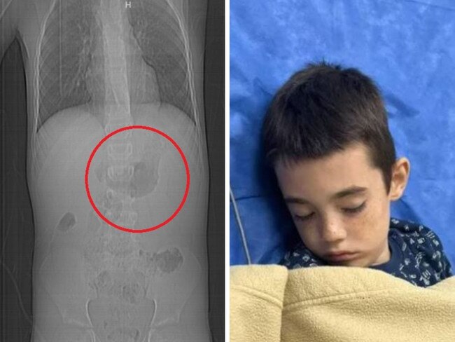 A seven-year-old boy from Perth fell on a concrete slab while in Cabo, Mexico and what was thought to be a ‘small trip’ turned out to be something far more serious. Picture: Supplied