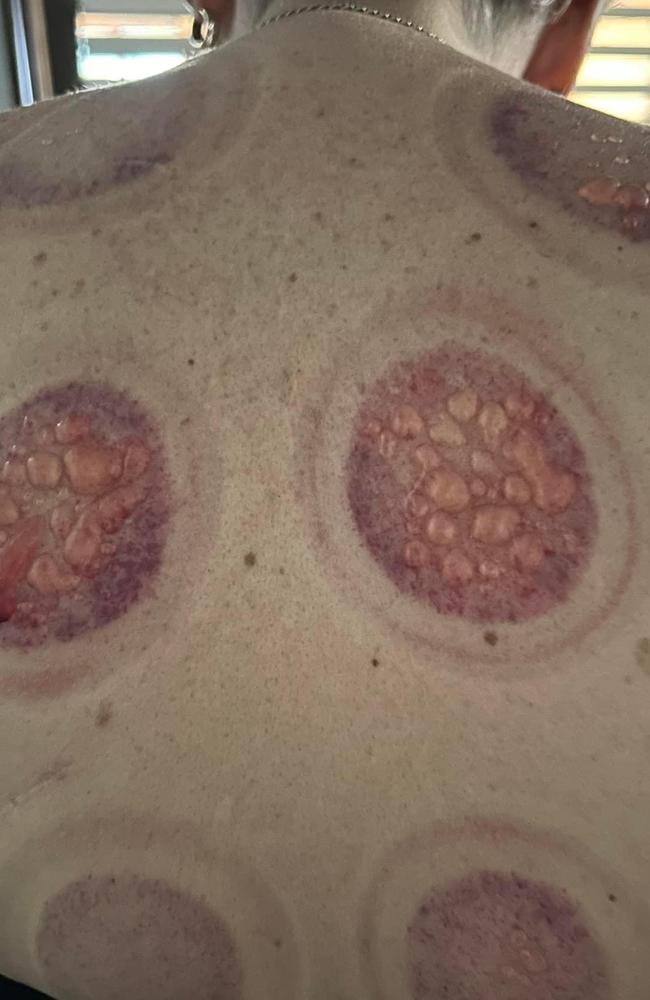 A woman has been left with painful, oozing cupping burns after a horror experience at the Logan shopping centre. Picture – Facebook.