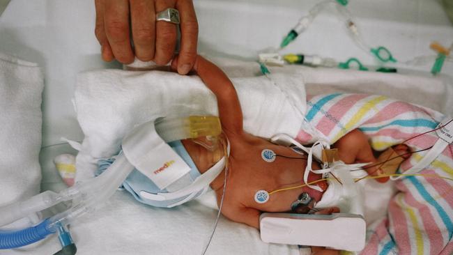 Tullah Clingeleffer was born at 31 weeks and is facing serious health challenges. Picture: Supplied