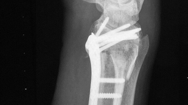 An X-Ray of Ali Day's broken wrist. Supplied.