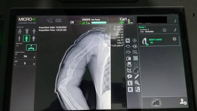 An X-ray showing the exit wound from a shot Ukrainian soldier taken on an Australian Micro-X Rover unit. Source: Micro X