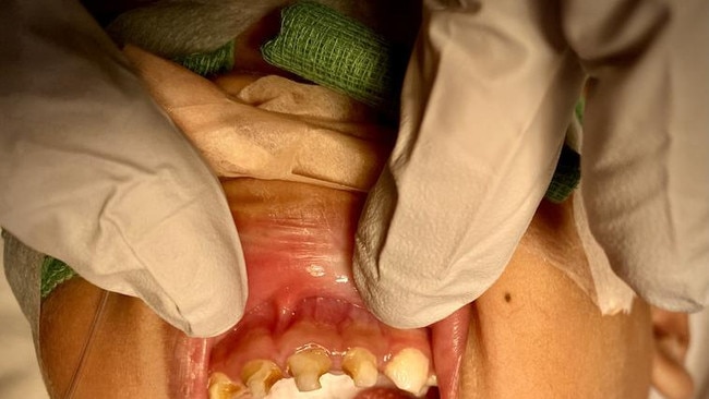 An unidentified young oral health patient from Far North Queensland who recently required surgery due to tooth decay. Picture: Supplied