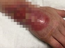 Aussies warned of 'flesh eating' disease.