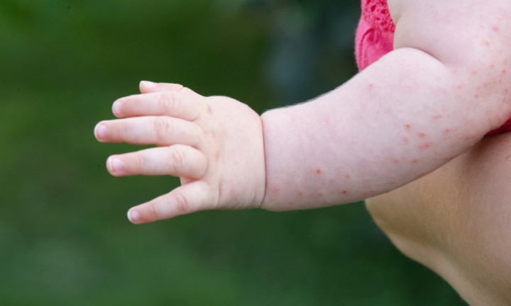 allergic reactions in children