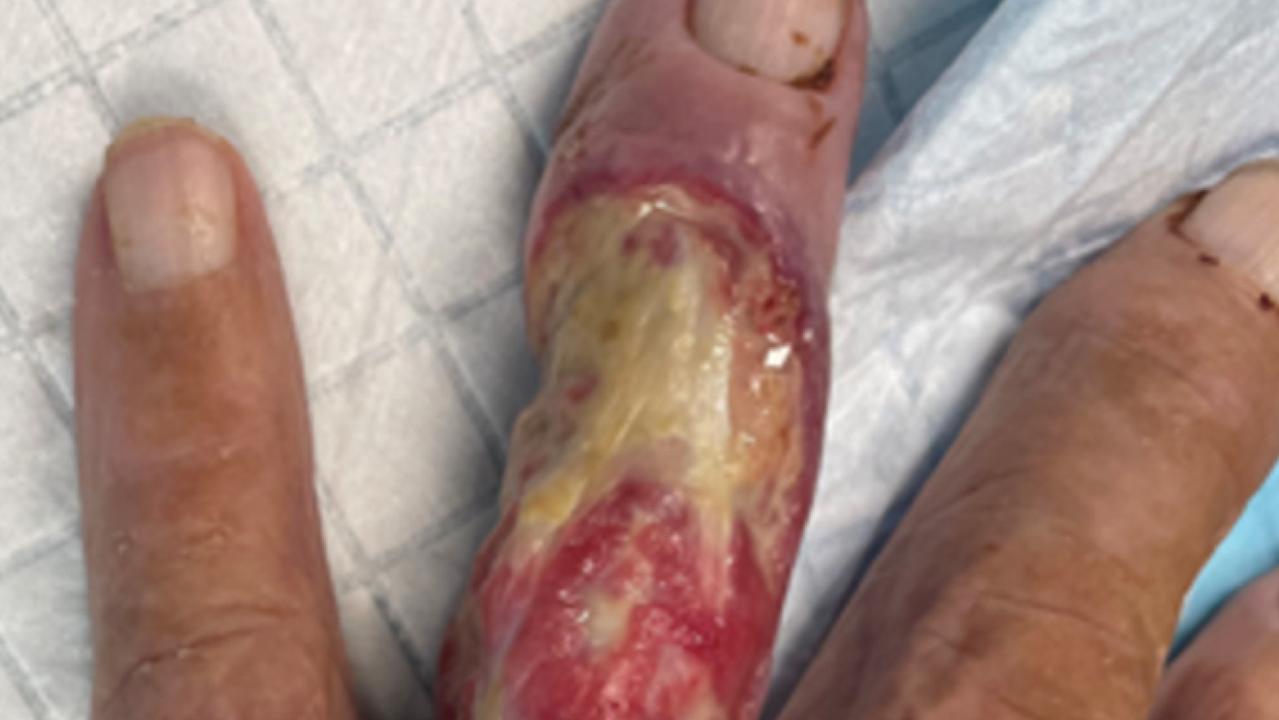 Two cases of Buruli have also been detected in Batemans Bay, NSW. In one case, a 94-year-old man suffered a gruesome infection on his finger. Picture: Neglected Tropical Diseases