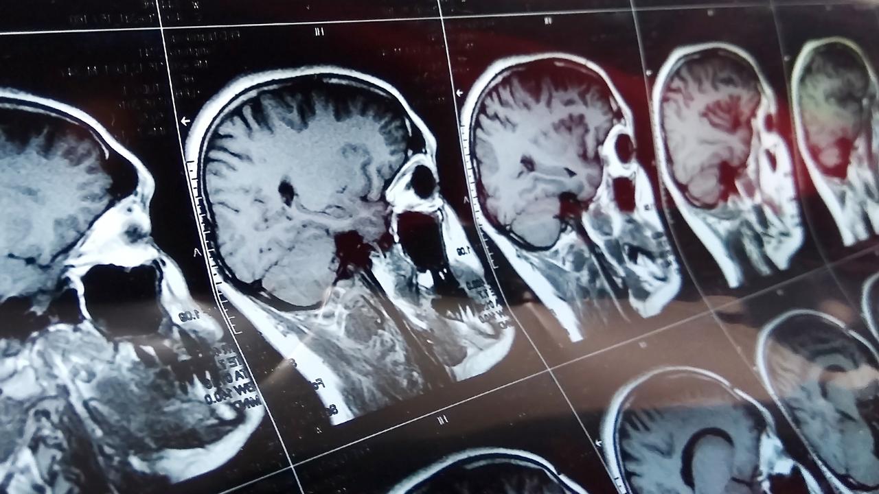 A brain scan can pick up cancerous tumours, but researchers hope a new therapy being developed could help cure them.