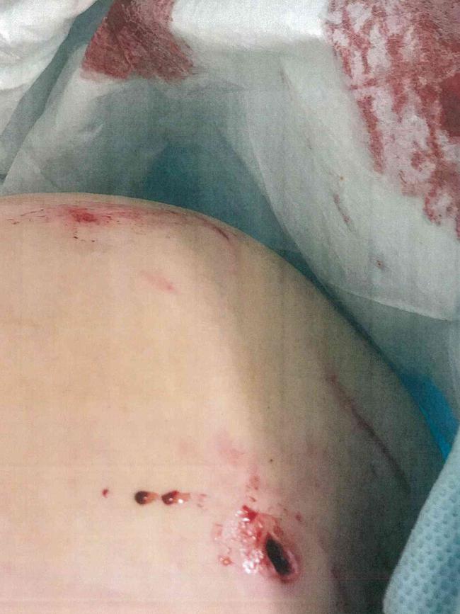 Photos showing a woman's injuries allegedly sustained by a bite from Sarge the staffy. Source: Moreton Bay Regional Council