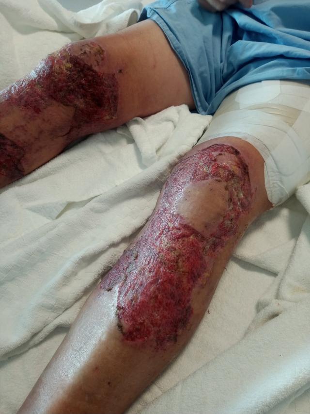 Gregory Orr of Crystal Brook in the RAH Burns Unit after suffering severe leg burns from wet cement. Picture Gregory Orr