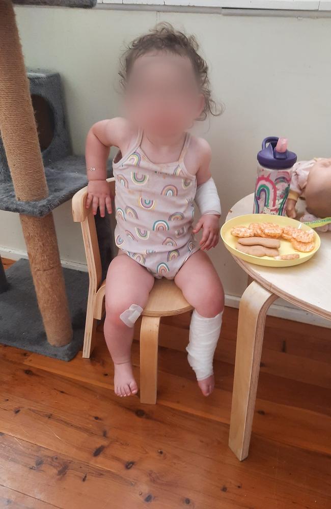 Little Lenny suffered first and second-degree burns when she fell onto a metal carousel at a playground in Sydney’s south west last month. Picture: Facebook