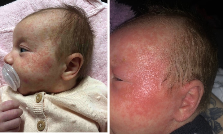 Eczema Mum S Baby Was So Bad She Was Blinded Kidspot