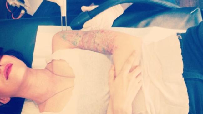 The Veronicas twin Jessica Origliasso documents her tattoo removal sessions on social media. Picture: Instagram