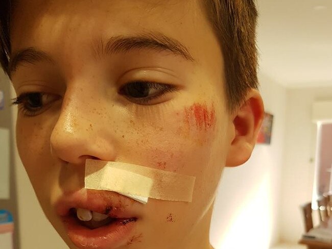 Jordan Walker, 11, was attacked by a magpie while riding his bike in Rowville.