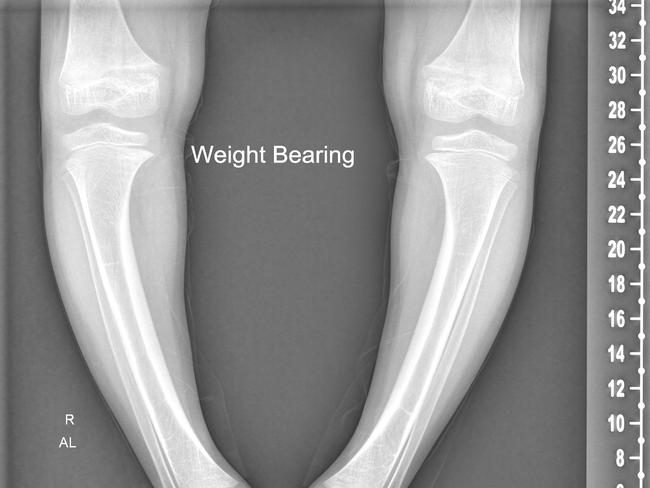 A rare kidney disease caused Bindisa Powaseu to develop bowed legs. An X-ray of her legs before recent surgery at the Queensland Children’s Hospital. The surgery will hopefully cause her legs to straighten over time.