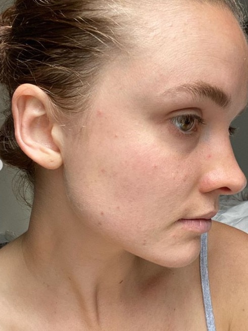 She said while she’s ‘lucky’ with her skin and understands breakouts aren’t big, it is a change from her ‘normal skin’. Picture: Instagram/LauraHenshaw