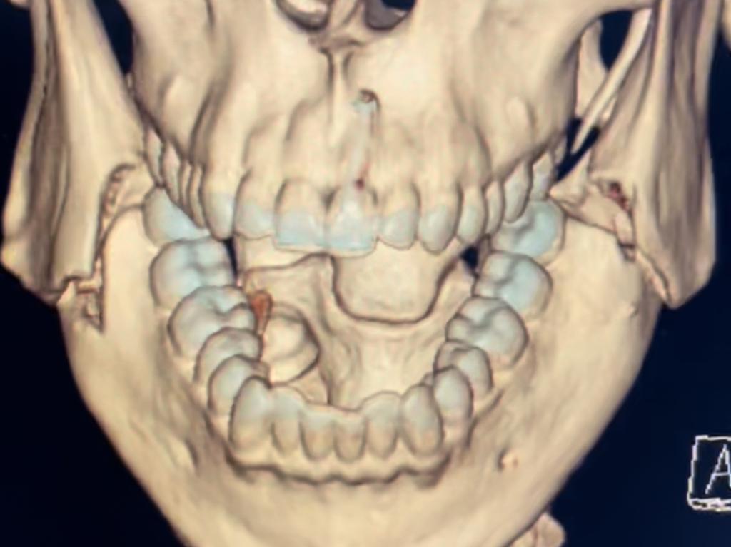 X-ray of the broken jaw.