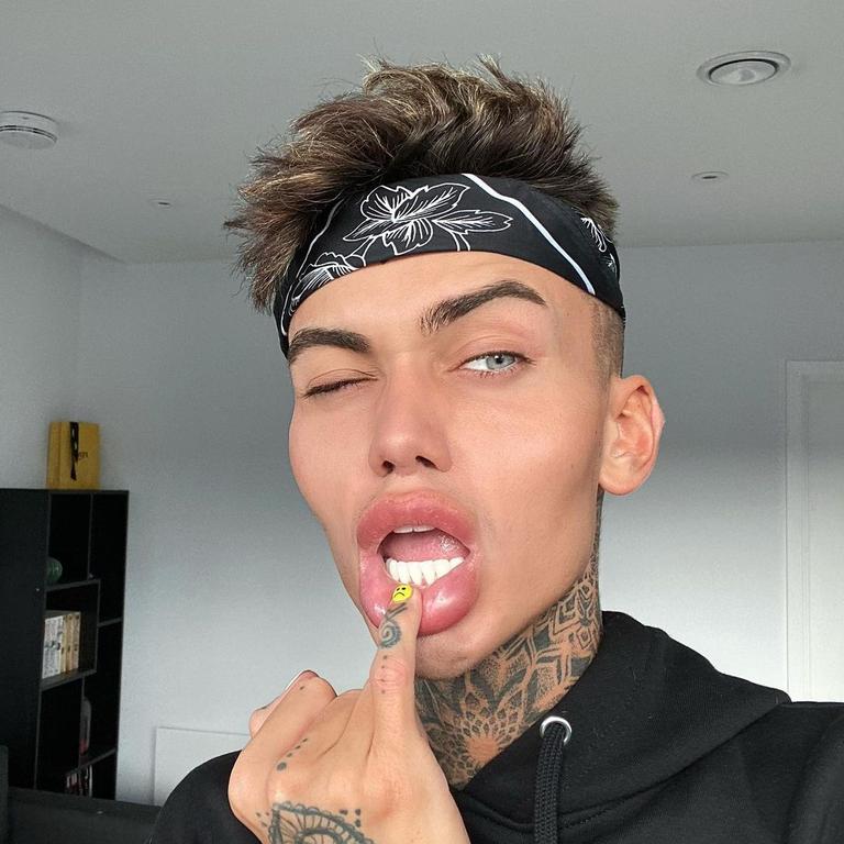 Levi has had nose and lip lifts, filler injections and straightened his teeth – with more surgeries planned. Picture: MDrum