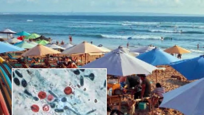 An outbreak of a gastro bug caused by a tiny parasite has been linked to overseas travel.