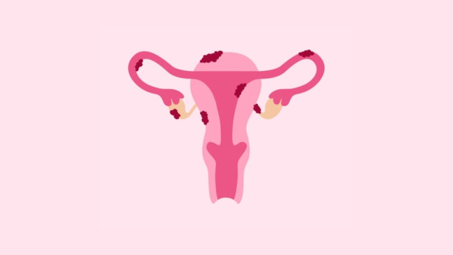 10 ways to better manage the symptoms of endometriosis. Image: iStock