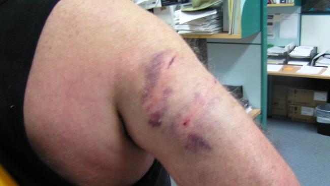 Ergon Energy file photos of previous injuries on meter readers.