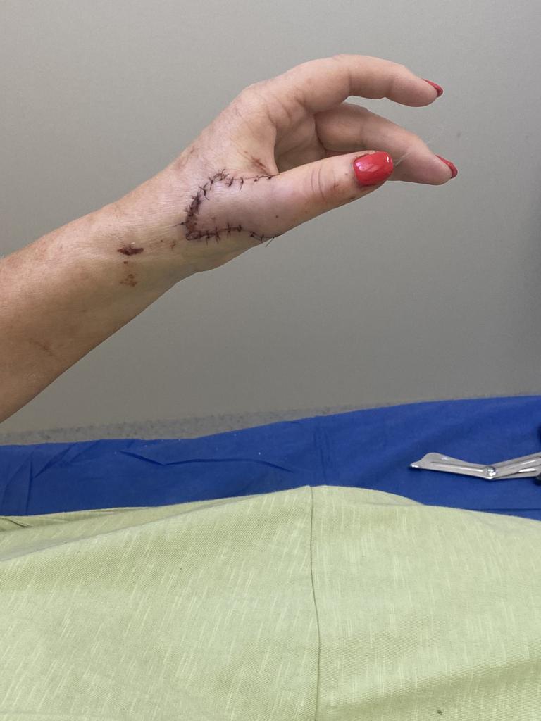 The injury to her hand. Picture: Supplied