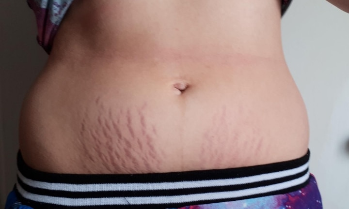 Pregnant Belly Stretch Mark Nude - Breast milk cured this mums stretch marks she says: Photos ...