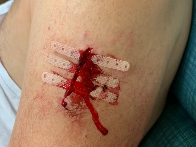 Hugo Stegmann suffered a 5cm wound to his arm. Picture: Supplied.