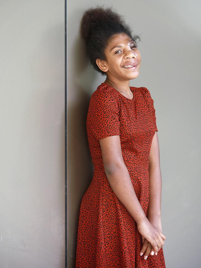 Vanuatu teen Jelsian Sur, 14, who has had a series of facial surgeries at the Queensland Children’s Hospital after being born with a microcystic lymphatic malformation, which resulted in her being stared at and made fun of. Picture: Claudia Baxter, AAP.