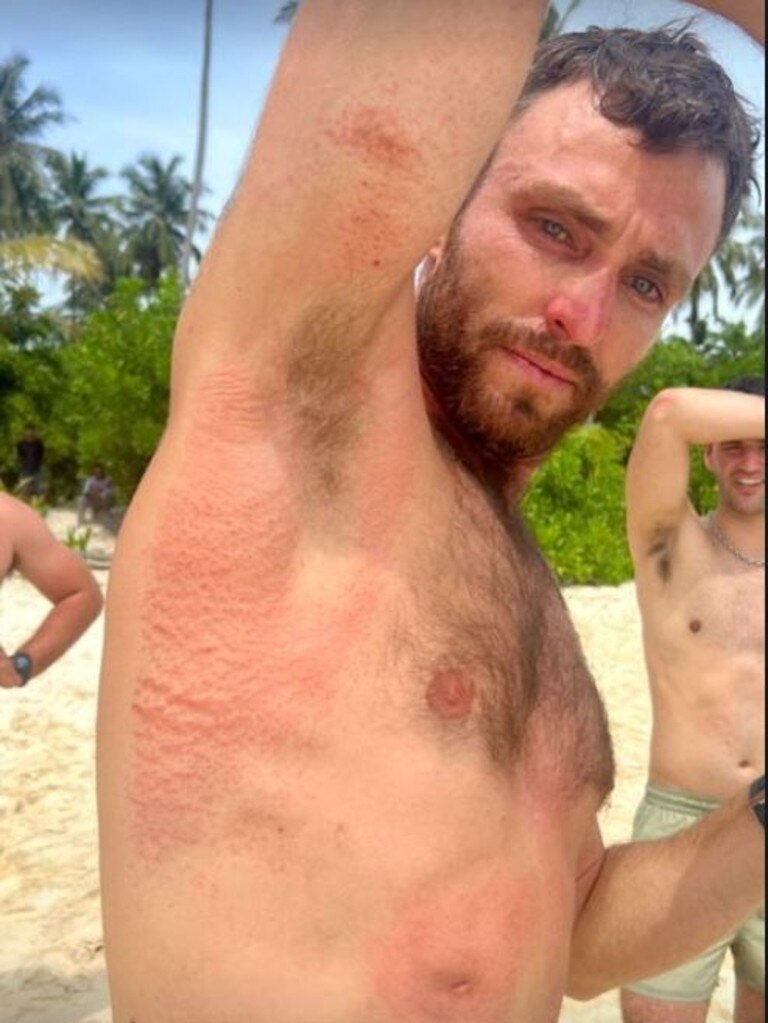 Elliot Foote was covered in injuries after spending hours in the ocean. Picture: Instagram