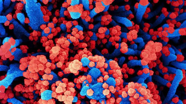 A colorised scanning electron micrograph of a cell (blue) heavily infected with SARS-CoV-2 virus particles (red), isolated from a patient sample. Picture: AFP