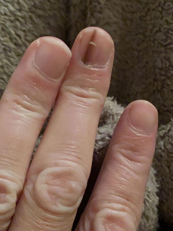 Elizabeth Misselbrook noticed a strange mark on her fingernail in September 2019. Picture: Kennedy News and Media