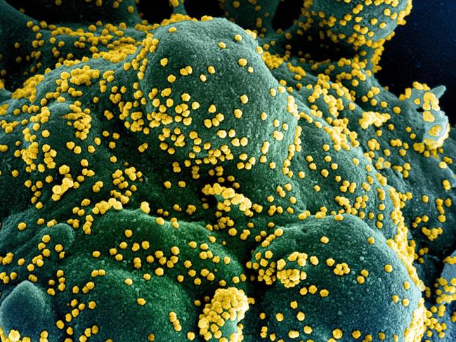 An apoptotic cell (blue/green) heavily infected with SARS-COV-2 virus particles (yellow), isolated from a patient sample, captured at the NIAID Integrated Research Facility (IRF) in Fort Detrick, Maryland. Picture: National Institute of Allergy and Infectious Diseases/AFP