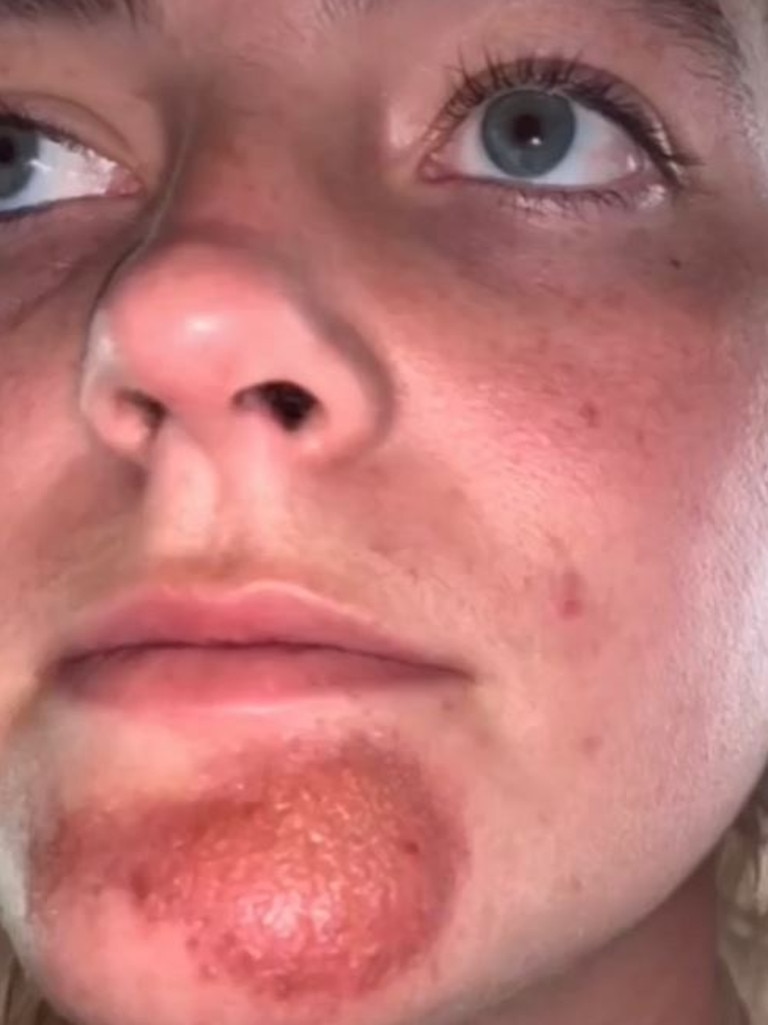 Woman develops staph infection after kissing man with stubble The