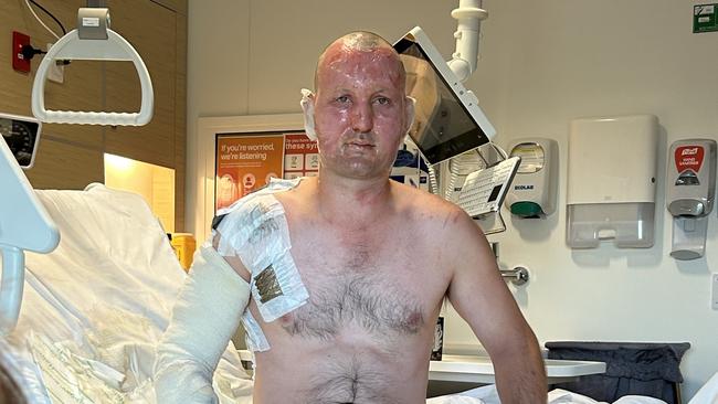 Adelaide man Adam Boots was burnt six months ago pouring accelerant onto a bonfire. Picture Supplied