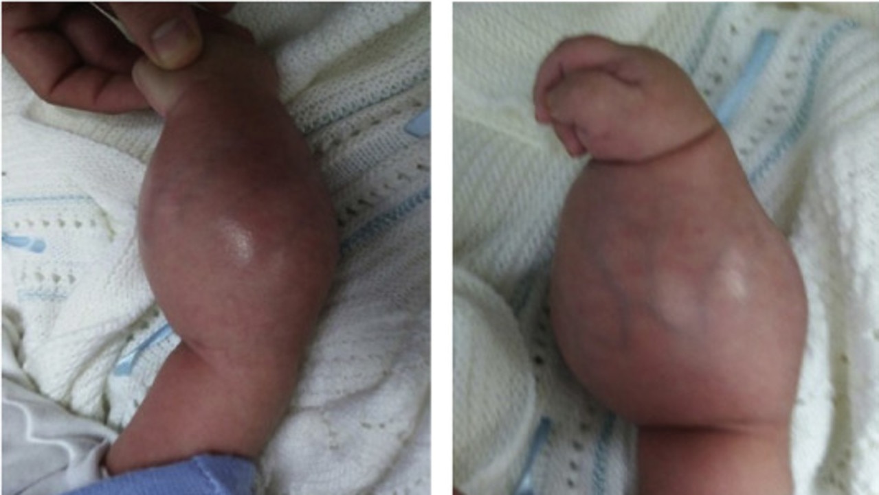 Congenital infantile fibrosarcoma tumours can be very large and protrude from the skin. Picture: ScienceDirect